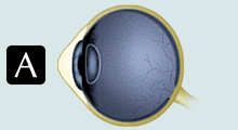 Astigmatism Art