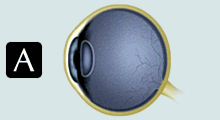 Hyperopia Art