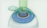 Refractive Surgery Art