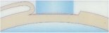 Refractive Surgery Art