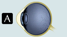 Myopia Art