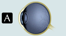 Presbyopia Art