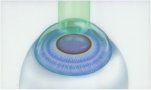 Refractive Surgery Art