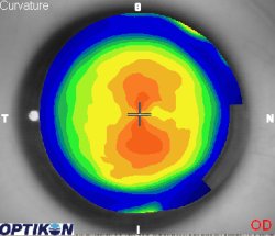 Corneal Topography Art