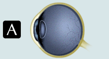 Refractive Error Presbyopia Art