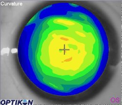 Orthok Demonstration - Patient 008