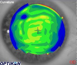 Orthok Demonstration - Patient 011